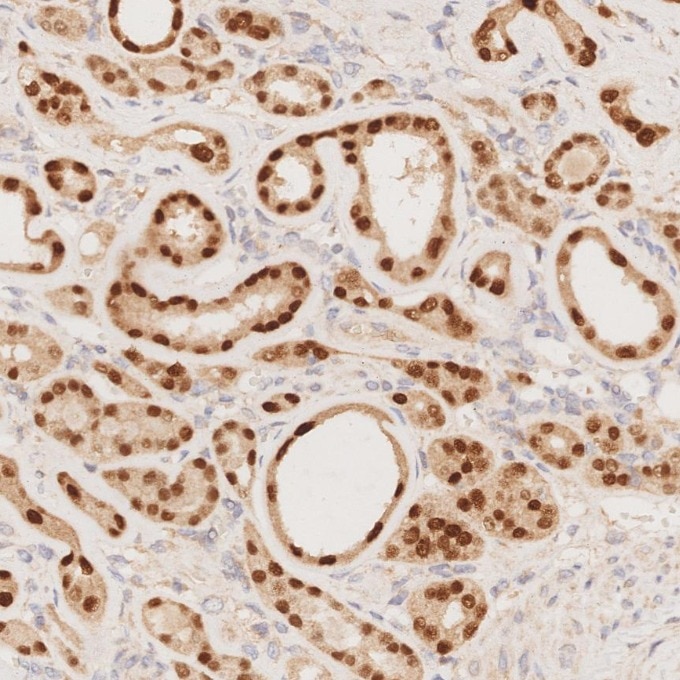 Immunohistochemistry (IHC) staining of human renal cell carcinoma tissue using PAX8 Recombinant monoclonal antibody (80756-1-RR)