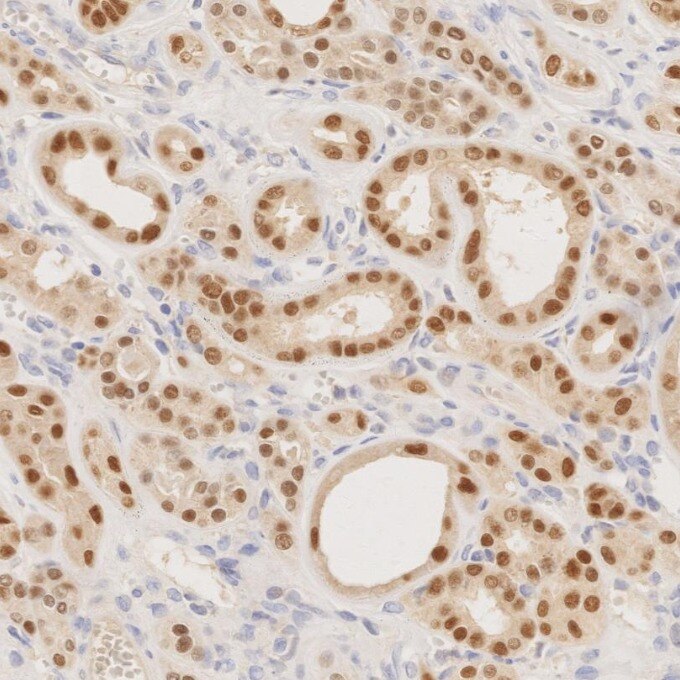 Immunohistochemistry (IHC) staining of human renal cell carcinoma tissue using PAX8 Recombinant monoclonal antibody (80756-1-RR)
