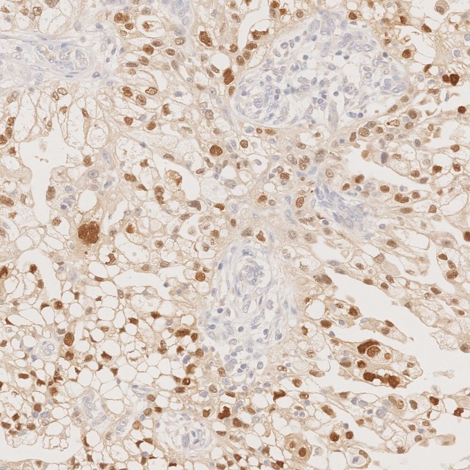 Immunohistochemistry (IHC) staining of human ovary cancer tissue using PAX8 Recombinant monoclonal antibody (80756-1-RR)