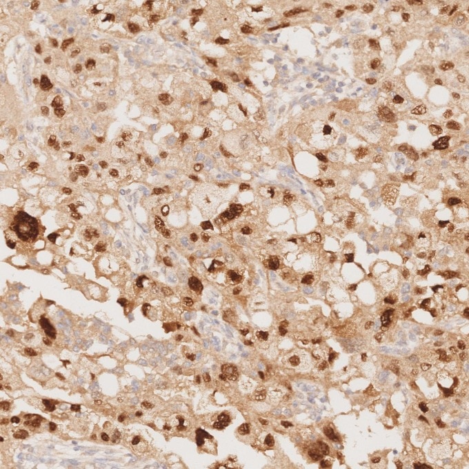 Immunohistochemistry (IHC) staining of human ovary cancer tissue using PAX8 Recombinant monoclonal antibody (80756-1-RR)