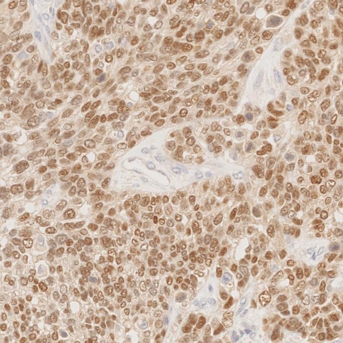 Immunohistochemistry (IHC) staining of human ovary cancer tissue using PAX8 Recombinant monoclonal antibody (80756-1-RR)
