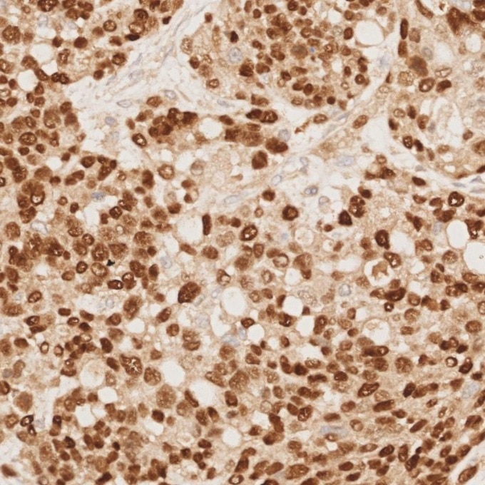 Immunohistochemistry (IHC) staining of human ovary cancer tissue using PAX8 Recombinant monoclonal antibody (80756-1-RR)