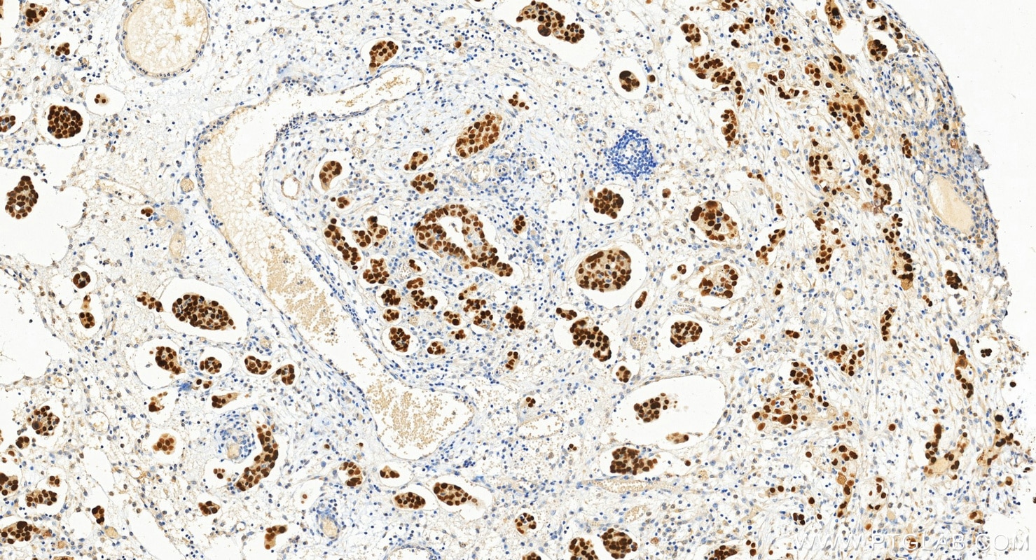 Immunohistochemistry (IHC) staining of human ovary cancer tissue using PAX8 Recombinant monoclonal antibody (80756-1-RR)