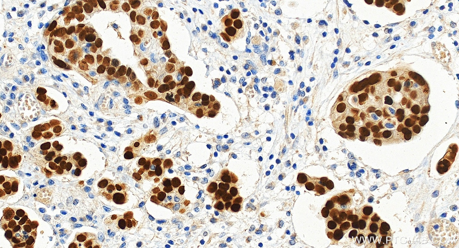 Immunohistochemistry (IHC) staining of human ovary cancer tissue using PAX8 Recombinant monoclonal antibody (80756-1-RR)