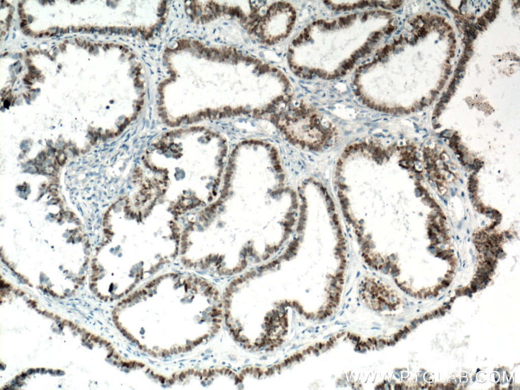 Immunohistochemistry (IHC) staining of human ovary tumor tissue using Biotin-conjugated PAX8 Monoclonal antibody (Biotin-60145)
