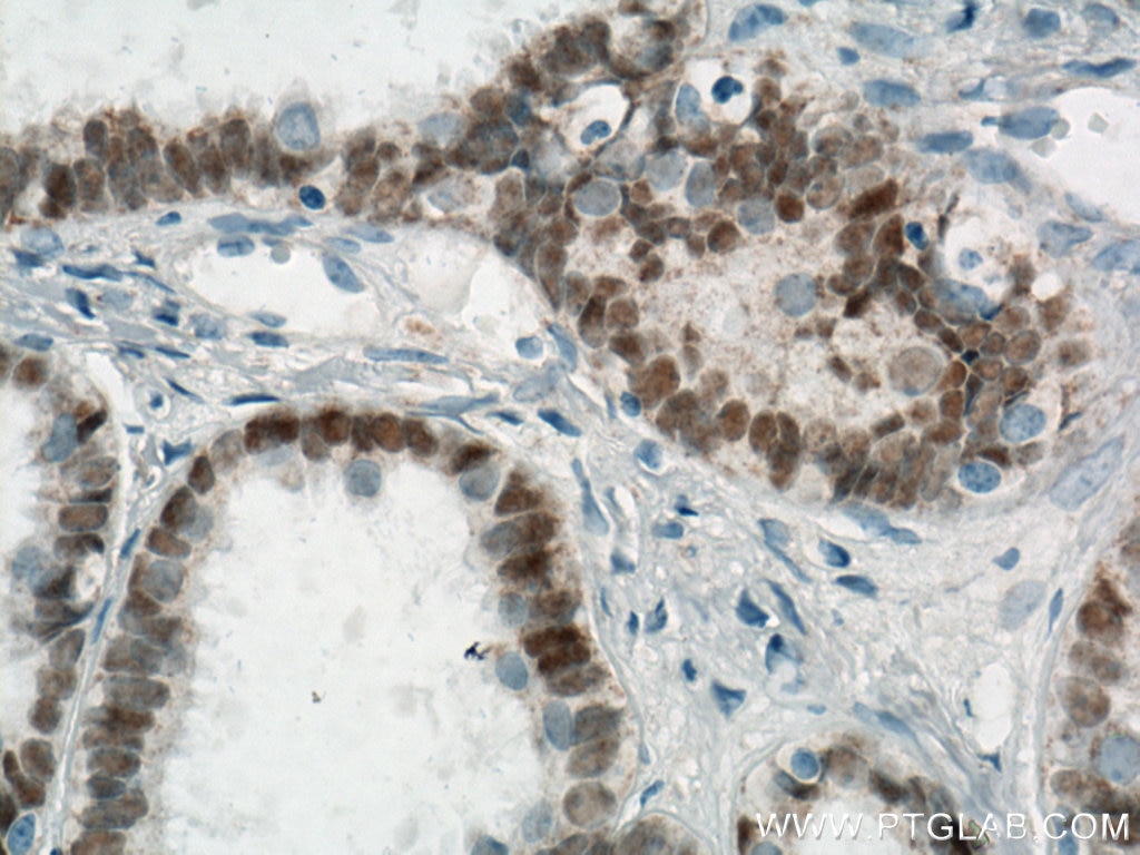 IHC staining of human ovary tumor using Biotin-60145