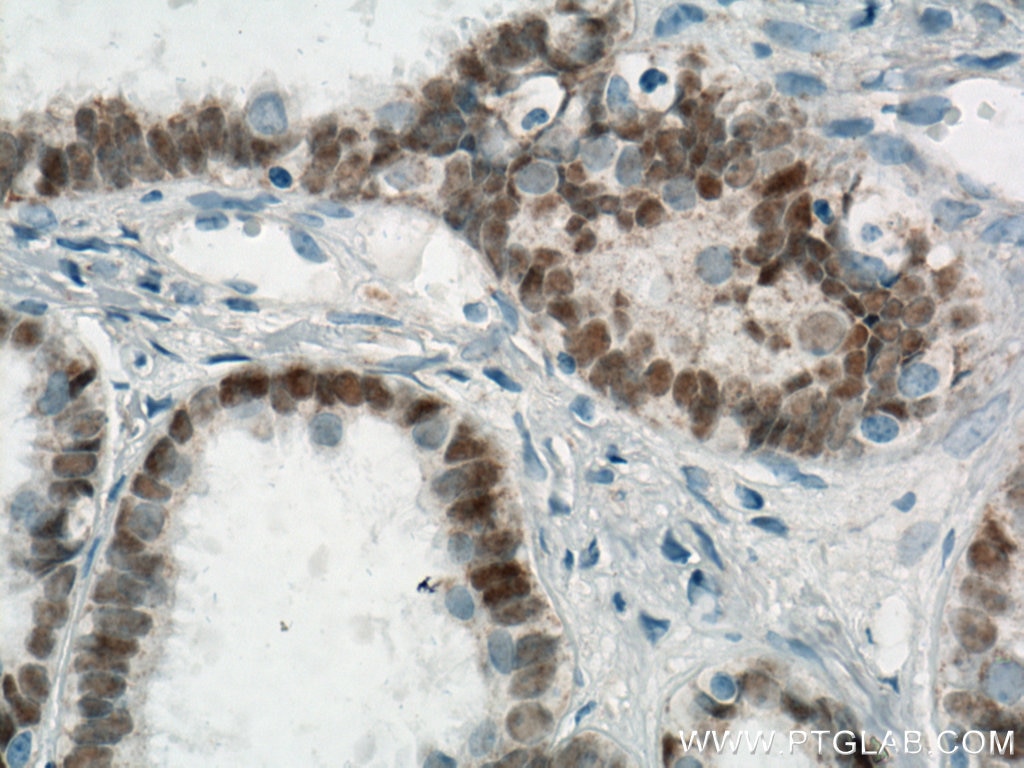 Immunohistochemistry (IHC) staining of human ovary tumor tissue using Biotin-conjugated PAX8 Monoclonal antibody (Biotin-60145)