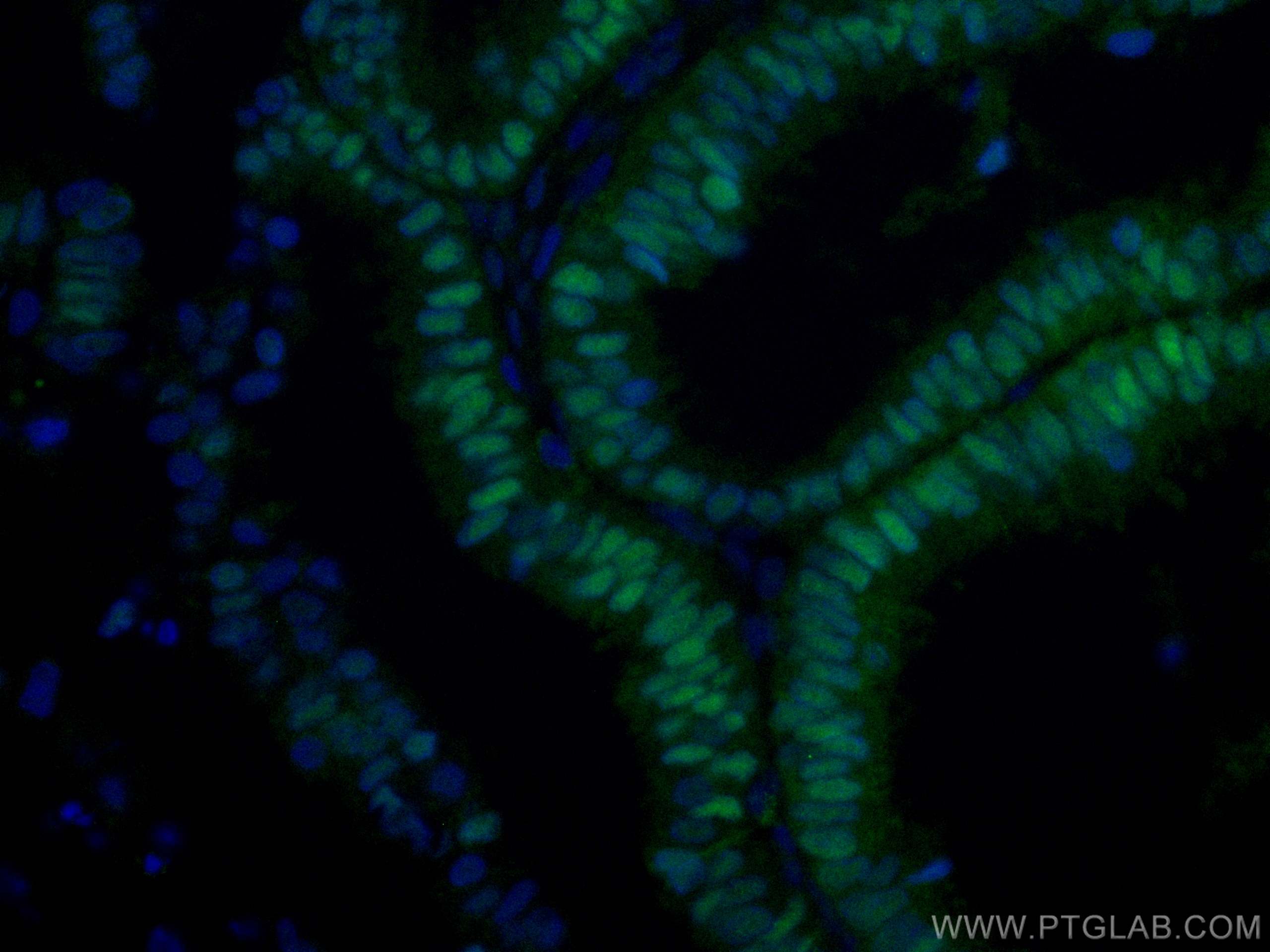 Immunofluorescence (IF) / fluorescent staining of human ovary tumor tissue using CoraLite® Plus 488-conjugated PAX8 Monoclonal anti (CL488-60145)