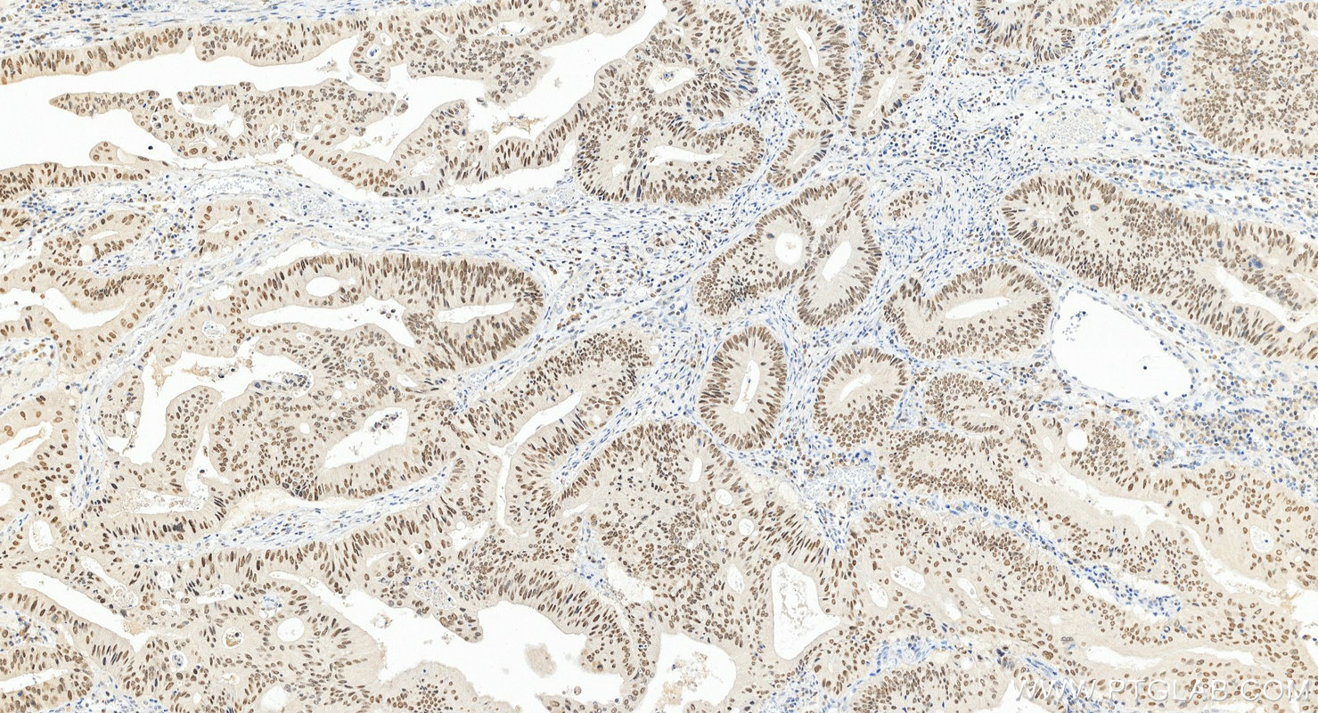 Immunohistochemistry (IHC) staining of human colon cancer tissue using PBRM1 Polyclonal antibody (12563-1-AP)