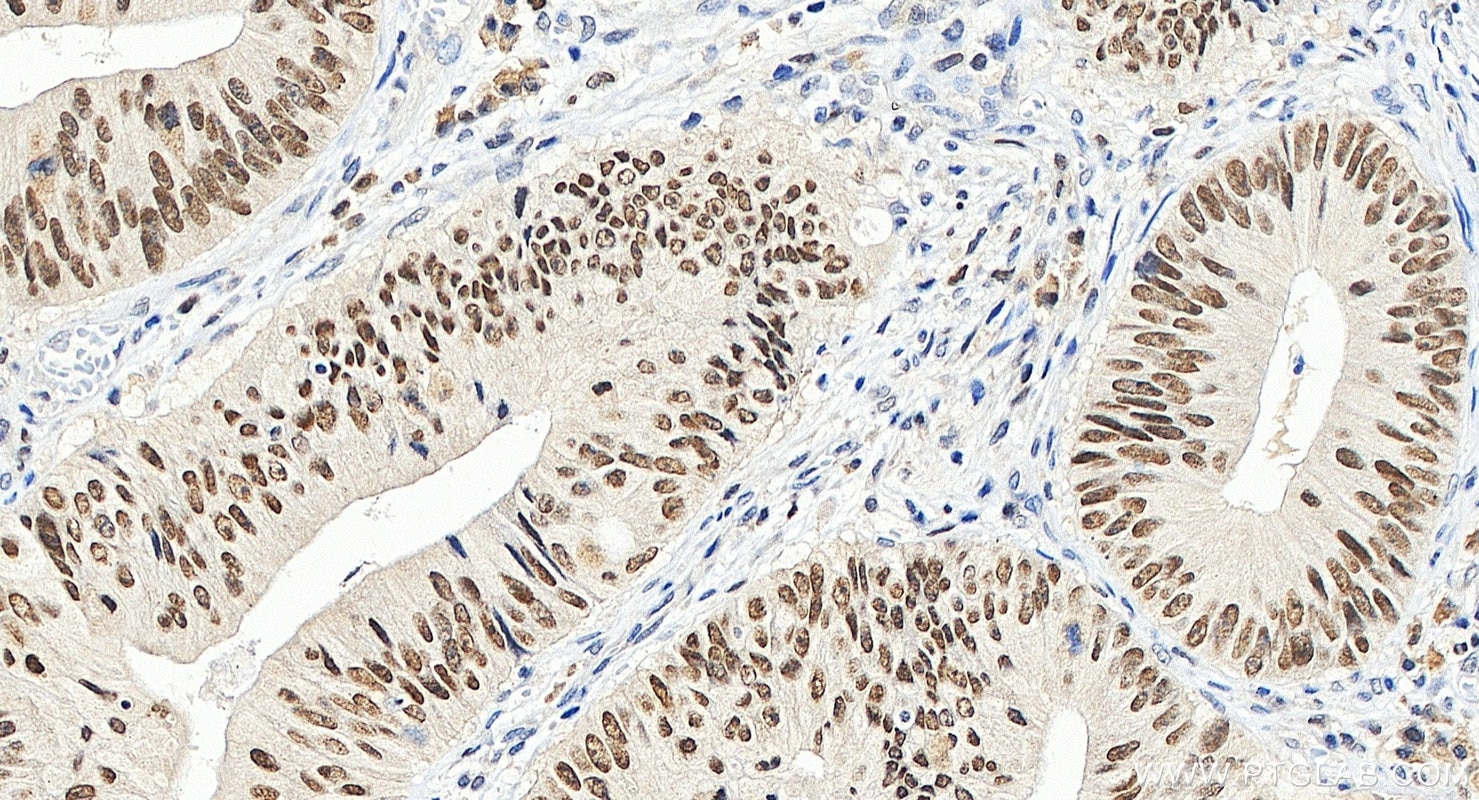 Immunohistochemistry (IHC) staining of human colon cancer tissue using PBRM1 Polyclonal antibody (12563-1-AP)