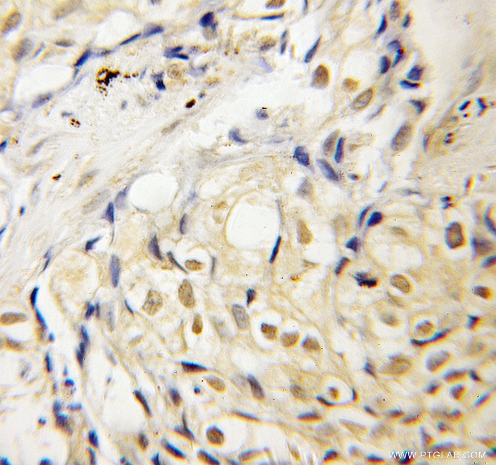 IHC staining of human lung cancer using 12571-1-AP