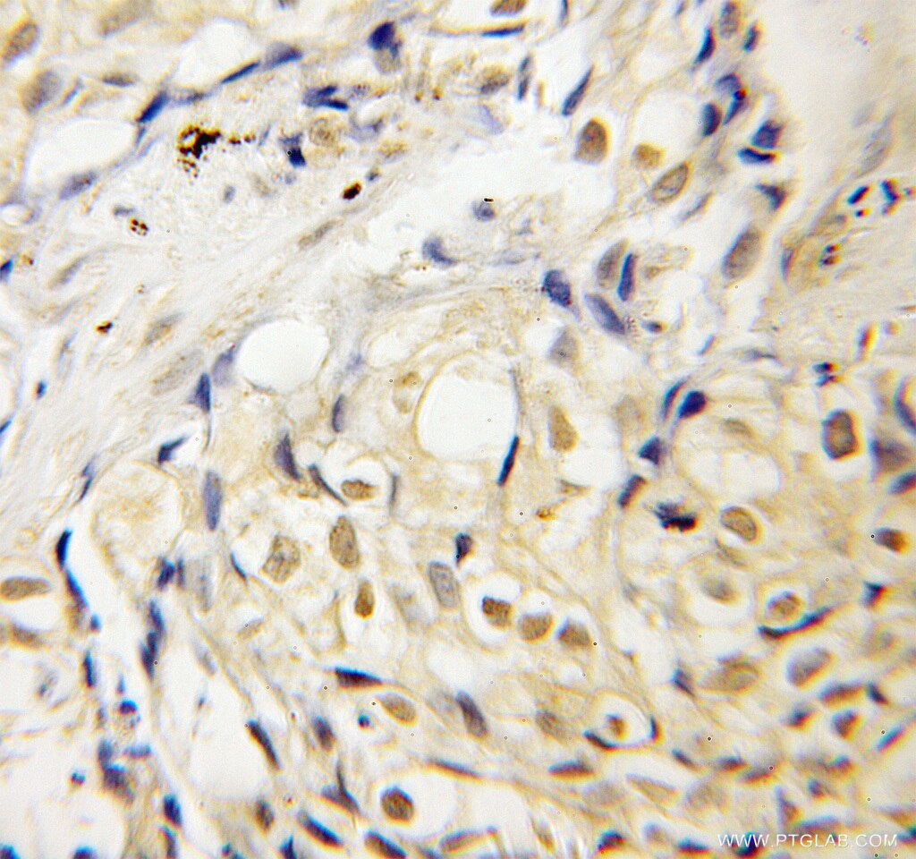 Immunohistochemistry (IHC) staining of human lung cancer tissue using PBX3 Polyclonal antibody (12571-1-AP)