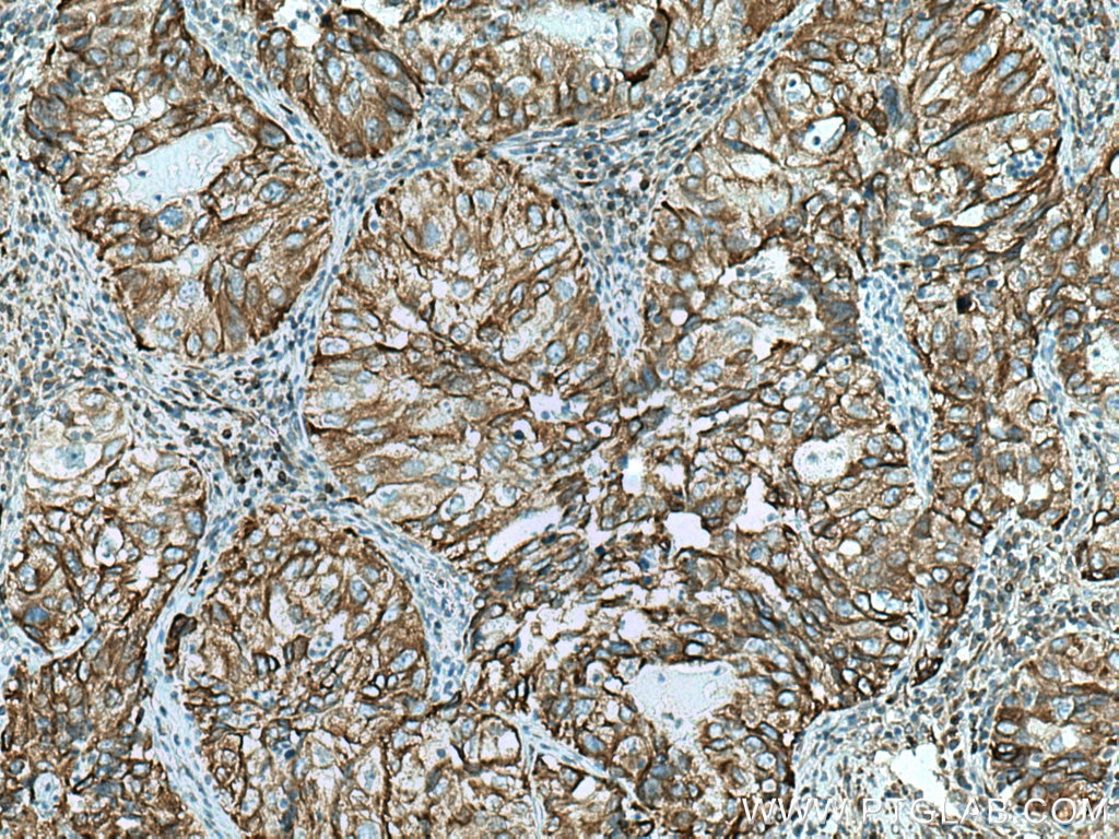 Immunohistochemistry (IHC) staining of human lung cancer tissue using PBXIP1 Polyclonal antibody (12102-1-AP)