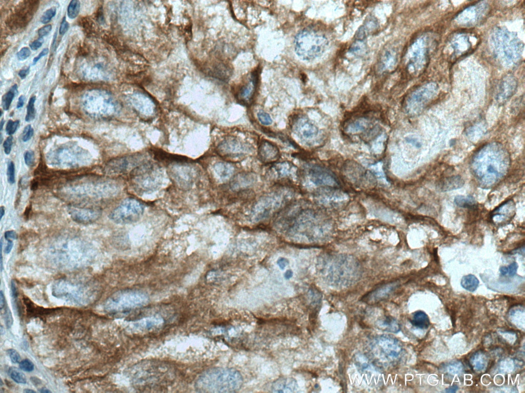 Immunohistochemistry (IHC) staining of human lung cancer tissue using PBXIP1 Polyclonal antibody (12102-1-AP)