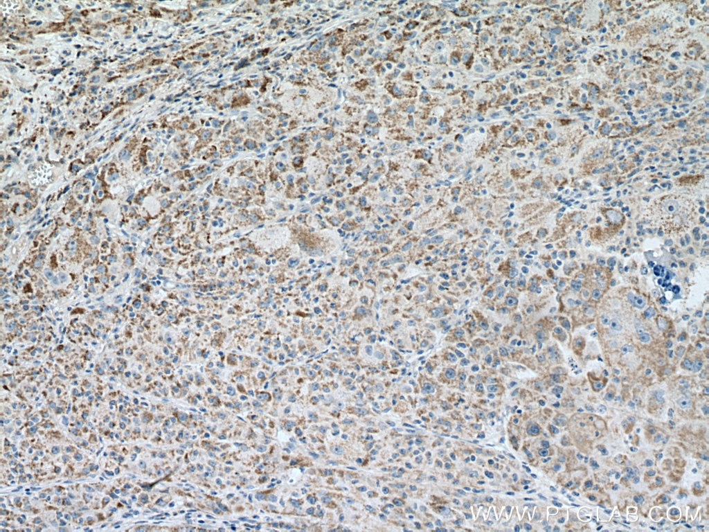 Immunohistochemistry (IHC) staining of human liver cancer tissue using Pyruvate Carboxylase Polyclonal antibody (16588-1-AP)