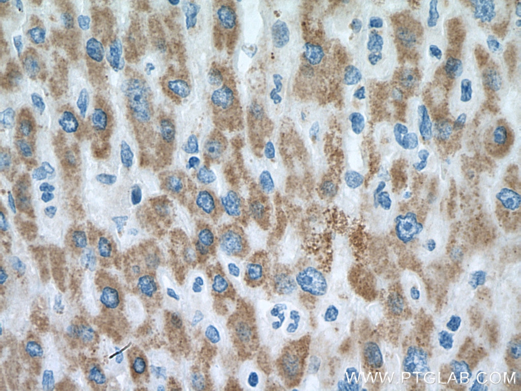 Immunohistochemistry (IHC) staining of human liver cancer tissue using Pyruvate Carboxylase Polyclonal antibody (16588-1-AP)