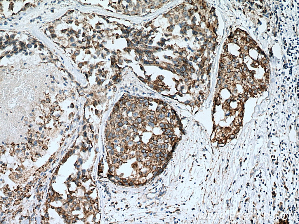 Immunohistochemistry (IHC) staining of human breast cancer tissue using Pyruvate Carboxylase Polyclonal antibody (16588-1-AP)