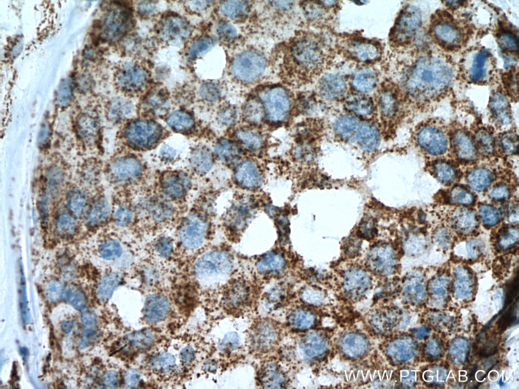 Immunohistochemistry (IHC) staining of human breast cancer tissue using Pyruvate Carboxylase Polyclonal antibody (16588-1-AP)