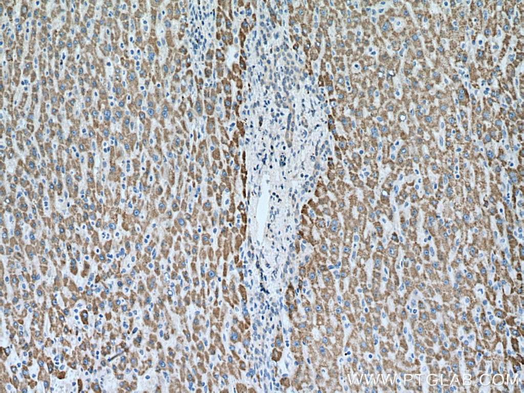 Immunohistochemistry (IHC) staining of human liver cancer tissue using Pyruvate Carboxylase Polyclonal antibody (16588-1-AP)