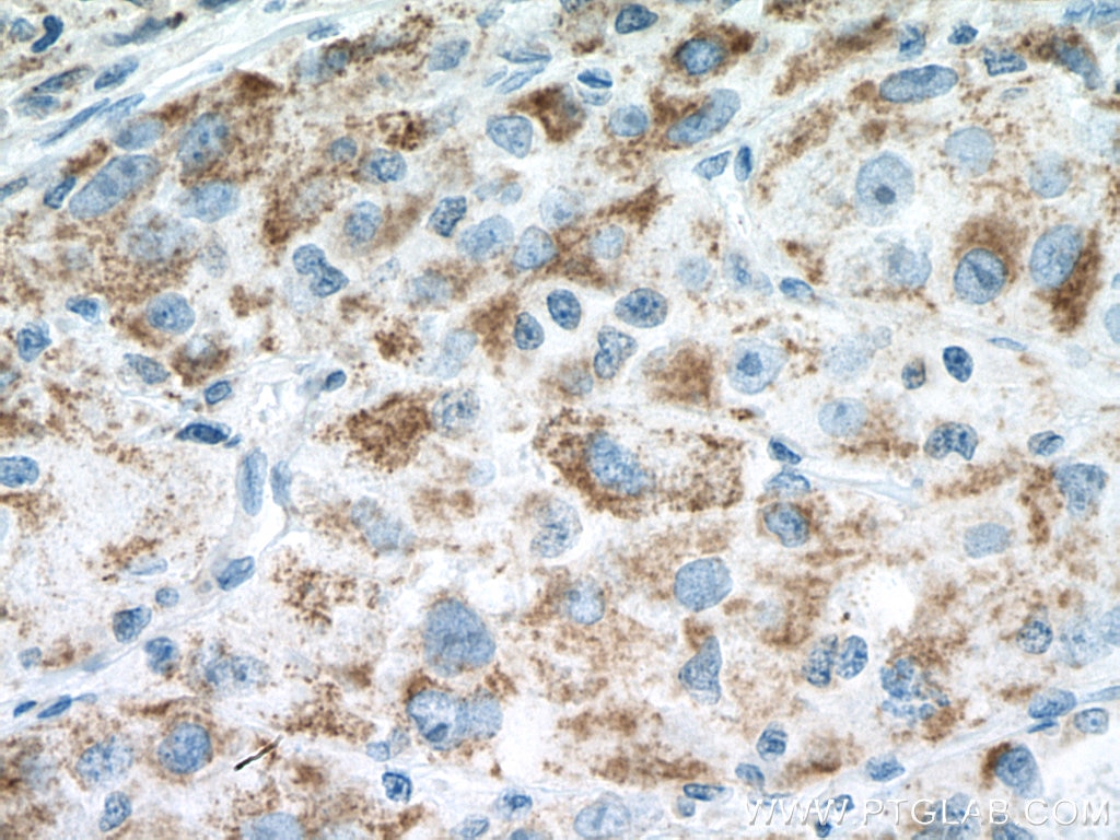 Immunohistochemistry (IHC) staining of human liver cancer tissue using Pyruvate Carboxylase Polyclonal antibody (16588-1-AP)