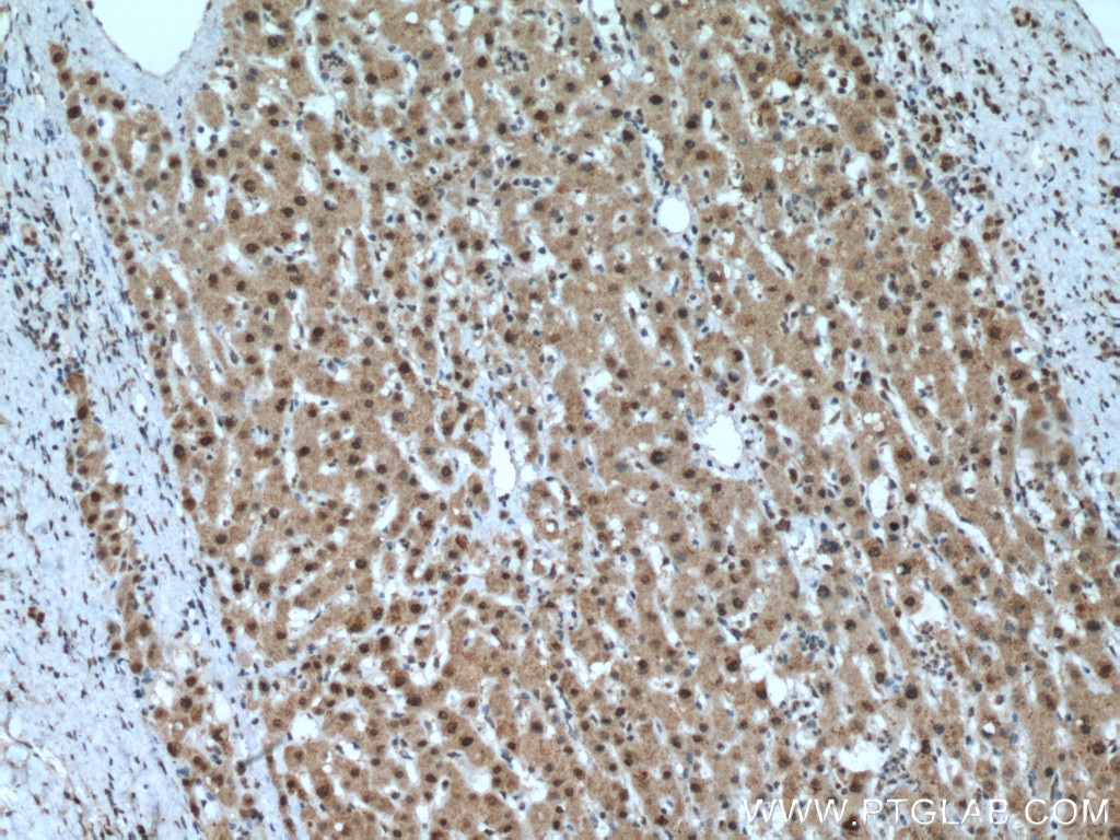 Immunohistochemistry (IHC) staining of human liver cancer tissue using PCBD1 Polyclonal antibody (15702-1-AP)