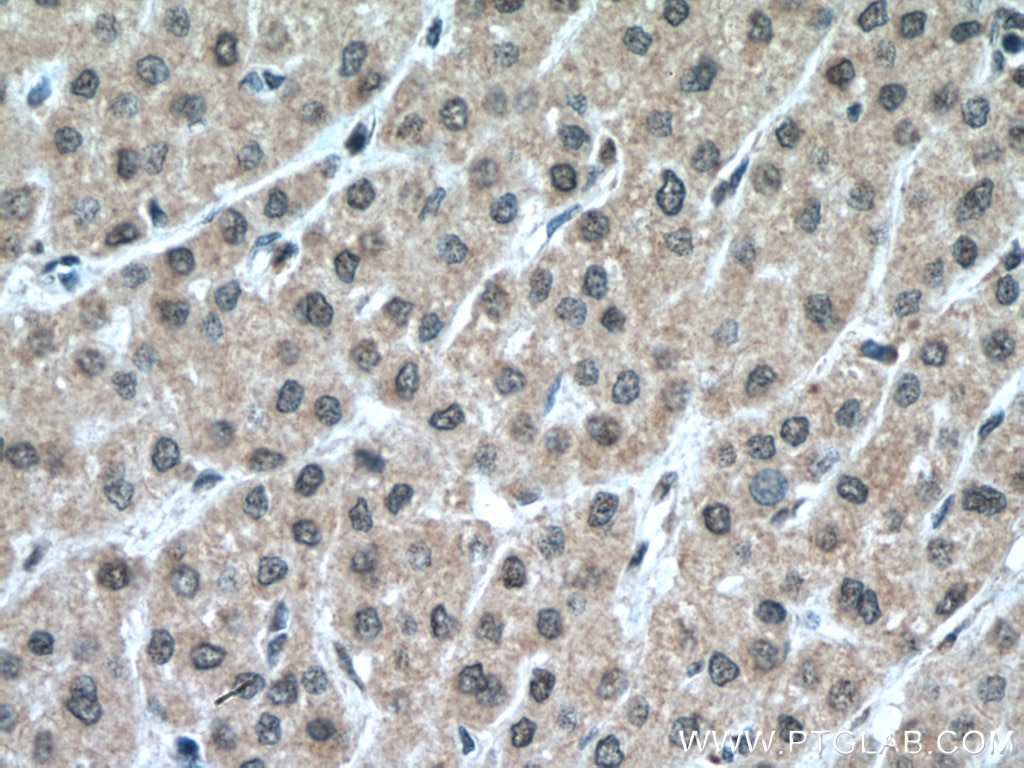 Immunohistochemistry (IHC) staining of human liver cancer tissue using PCBD1 Polyclonal antibody (15702-1-AP)
