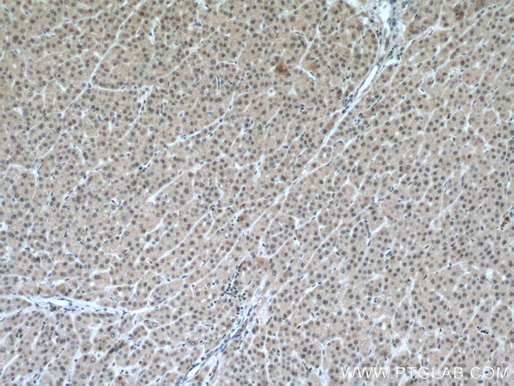 Immunohistochemistry (IHC) staining of human liver cancer tissue using PCBD1 Polyclonal antibody (15702-1-AP)