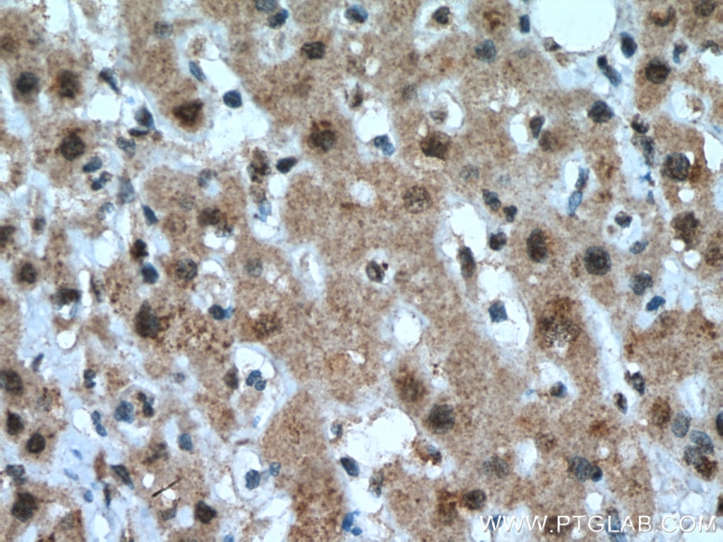 Immunohistochemistry (IHC) staining of human liver cancer tissue using PCBD1 Polyclonal antibody (15702-1-AP)