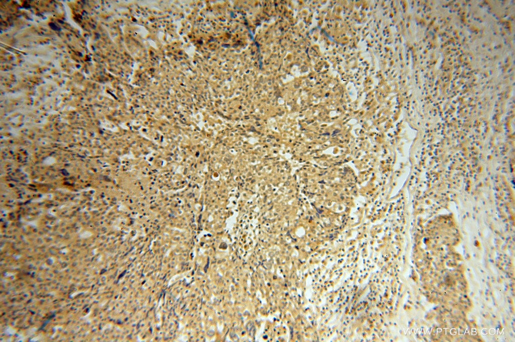 Immunohistochemistry (IHC) staining of human ovary tumor tissue using PCBD1 Polyclonal antibody (15702-1-AP)