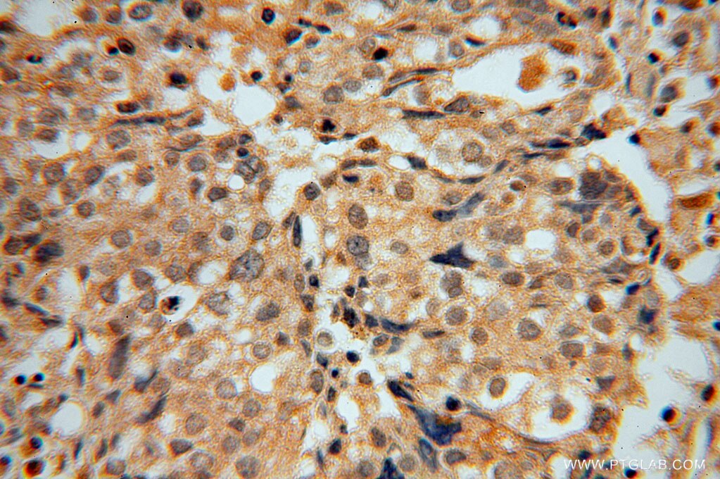 Immunohistochemistry (IHC) staining of human ovary tumor tissue using PCBD1 Polyclonal antibody (15702-1-AP)