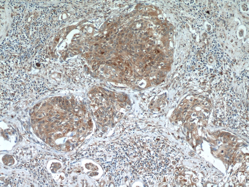 Immunohistochemistry (IHC) staining of human cervical cancer tissue using PCBP2 Polyclonal antibody (15070-1-AP)