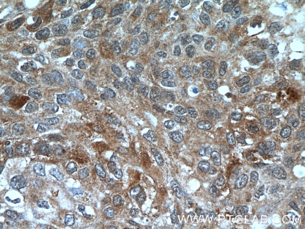 Immunohistochemistry (IHC) staining of human cervical cancer tissue using PCBP2 Polyclonal antibody (15070-1-AP)