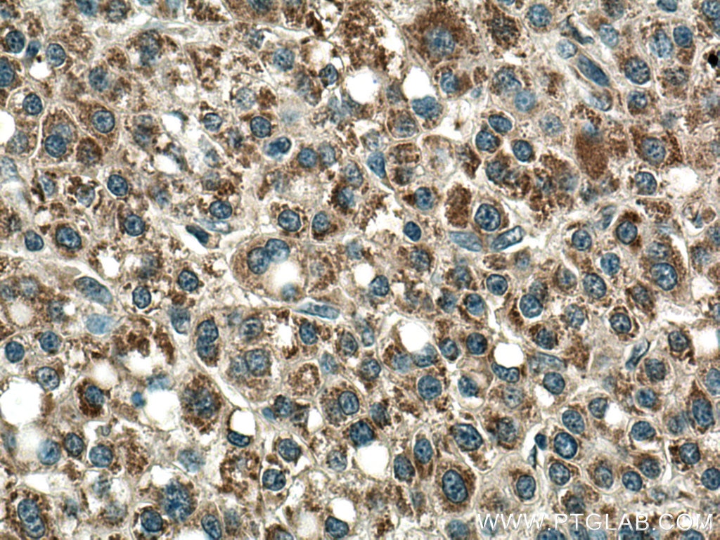 Immunohistochemistry (IHC) staining of human liver cancer tissue using PCCA Polyclonal antibody (21988-1-AP)