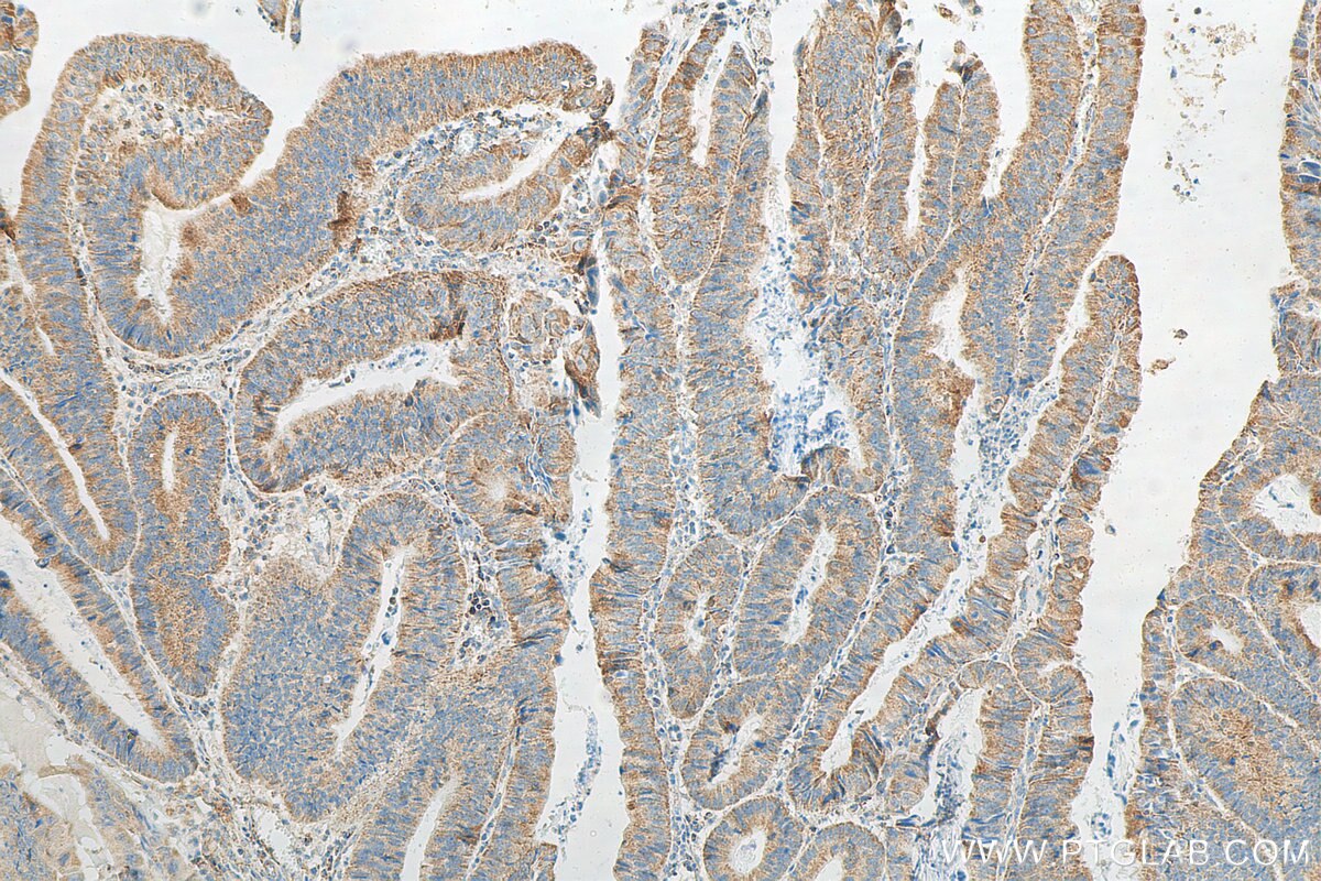 Immunohistochemistry (IHC) staining of human colon cancer tissue using Granulin Polyclonal antibody (10053-1-AP)