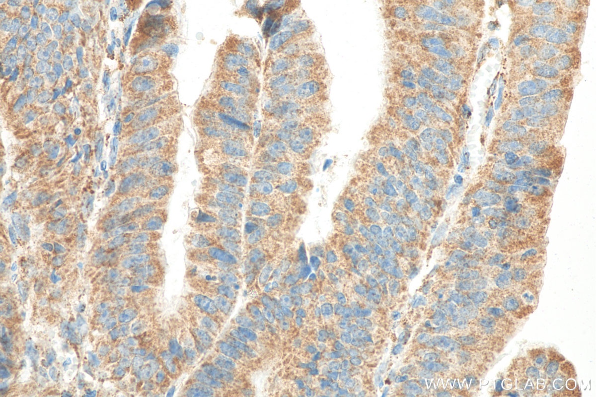 Immunohistochemistry (IHC) staining of human colon cancer tissue using Granulin Polyclonal antibody (10053-1-AP)