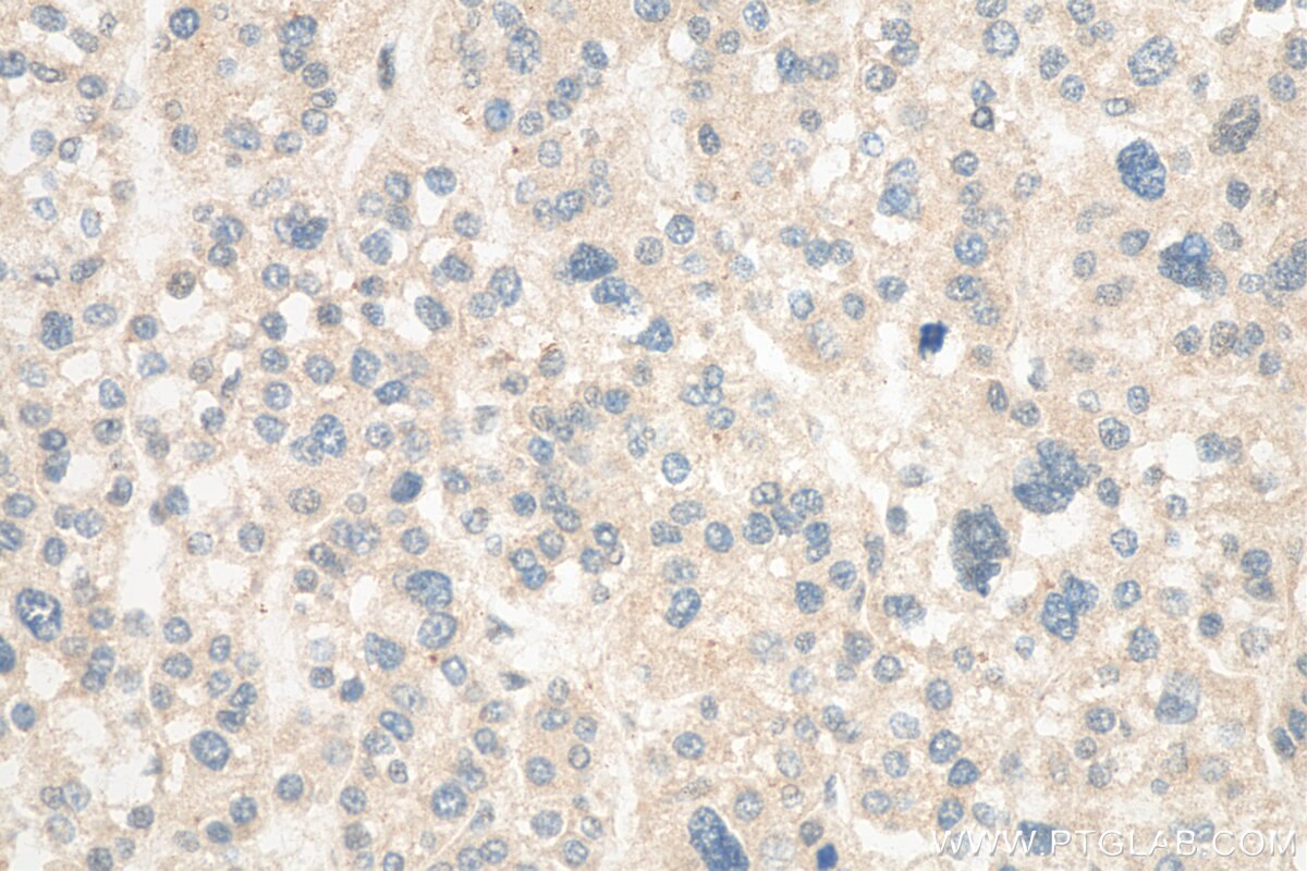 Immunohistochemistry (IHC) staining of human liver cancer tissue using Granulin Polyclonal antibody (10053-1-AP)