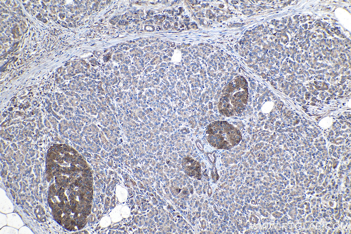 Immunohistochemistry (IHC) staining of human pancreas cancer tissue using Granulin Polyclonal antibody (18410-1-AP)