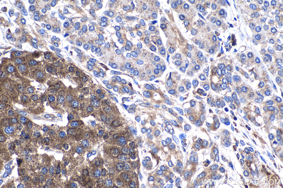 Immunohistochemistry (IHC) staining of human pancreas cancer tissue using Granulin Polyclonal antibody (18410-1-AP)