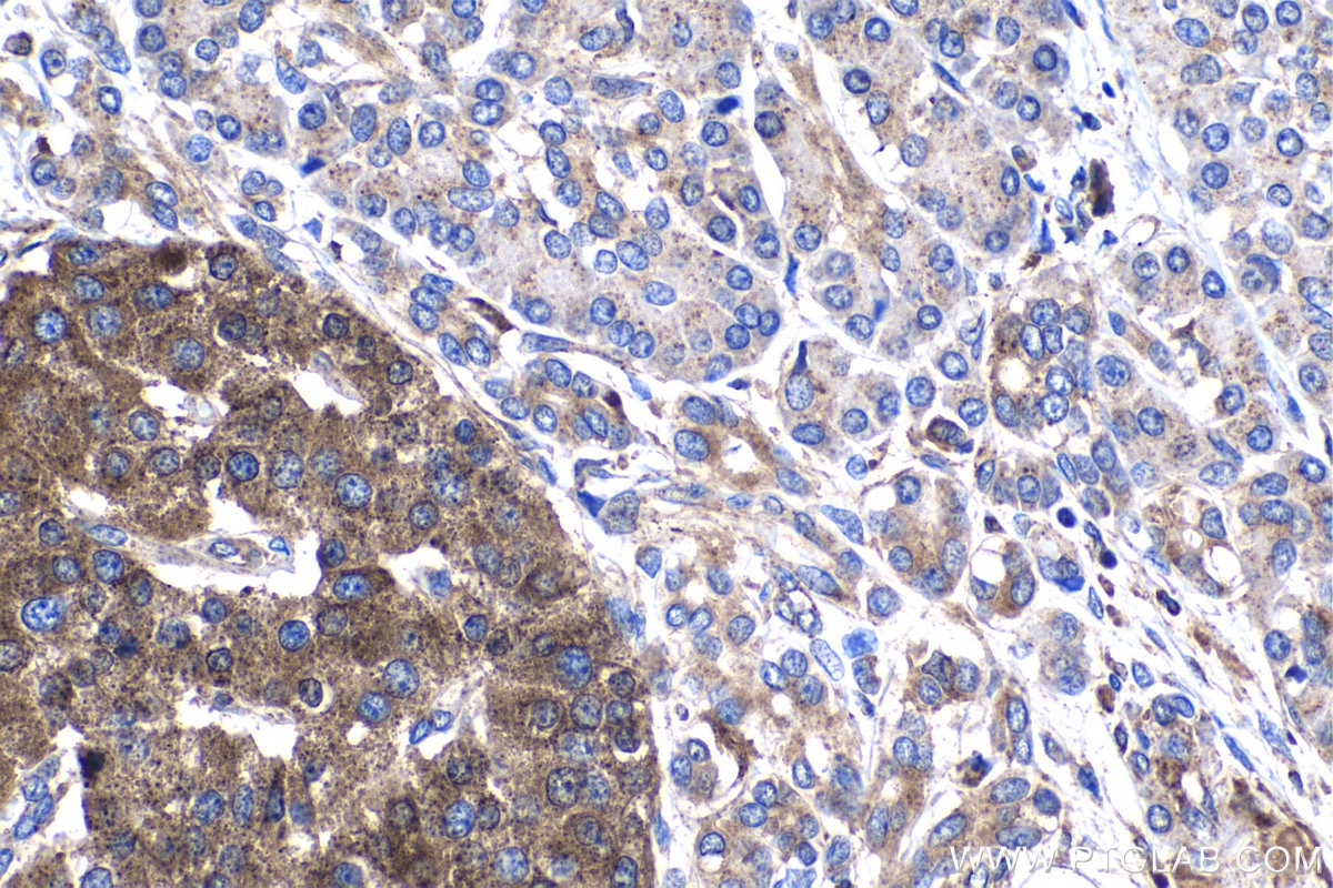 IHC staining of human pancreas cancer using 18410-1-AP