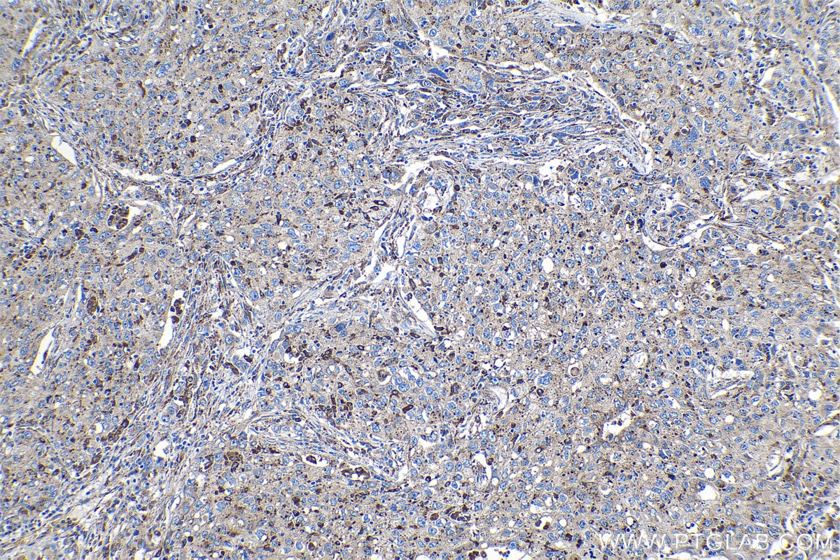 Immunohistochemistry (IHC) staining of human lung cancer tissue using Granulin Polyclonal antibody (18410-1-AP)