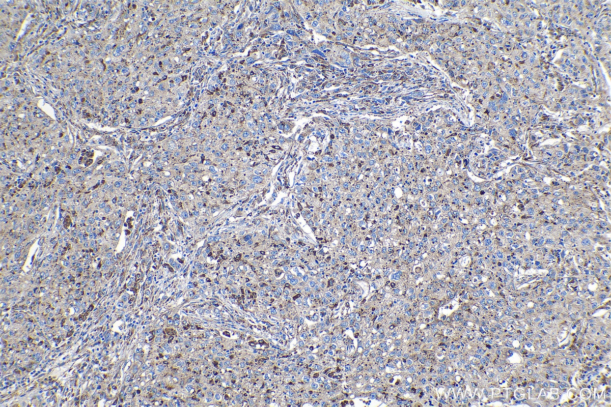 IHC staining of human lung cancer using 18410-1-AP