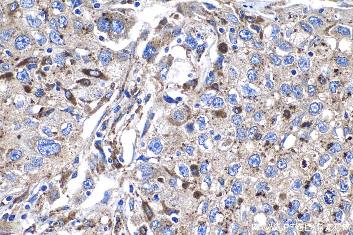 Immunohistochemistry (IHC) staining of human lung cancer tissue using Granulin Polyclonal antibody (18410-1-AP)