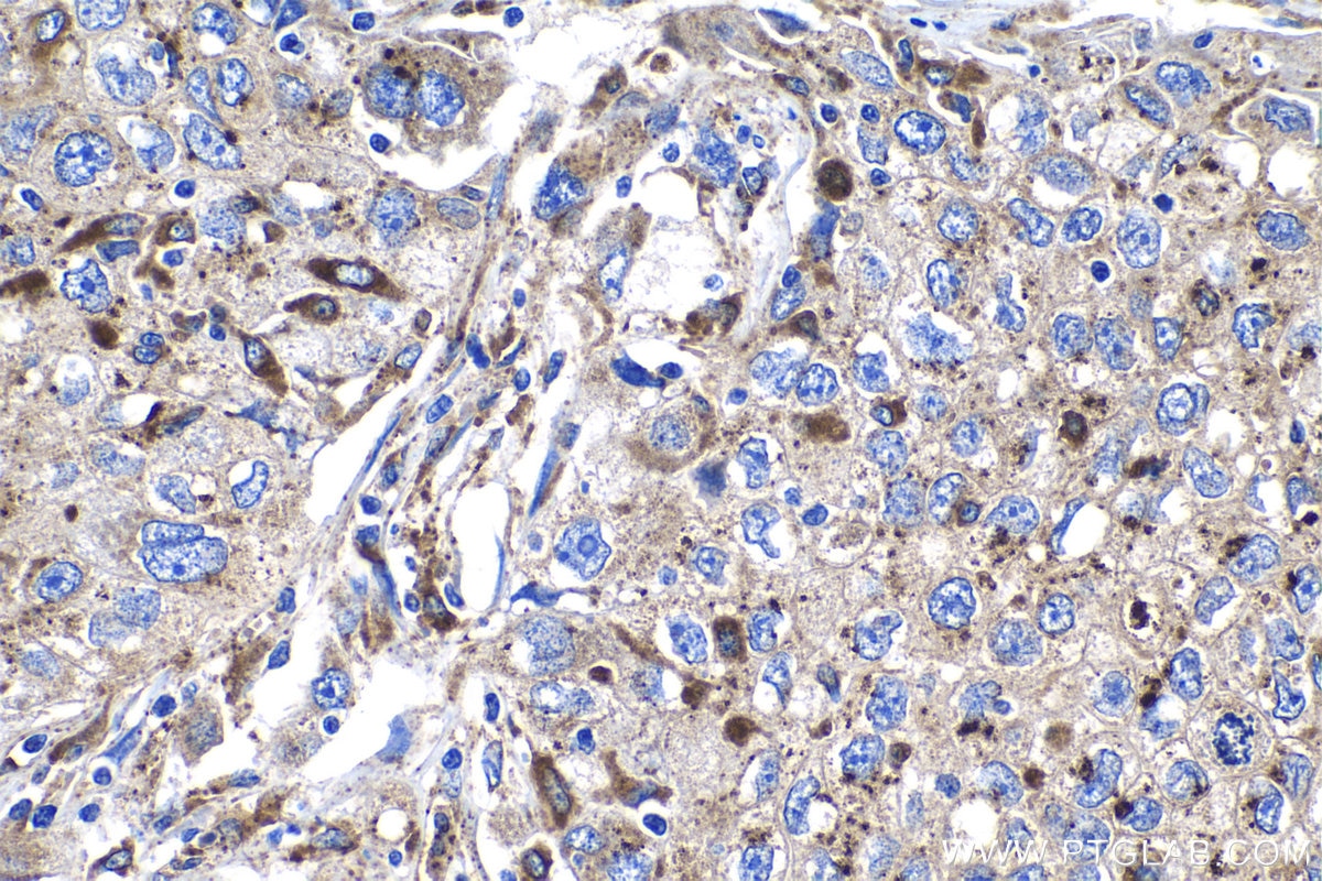 IHC staining of human lung cancer using 18410-1-AP