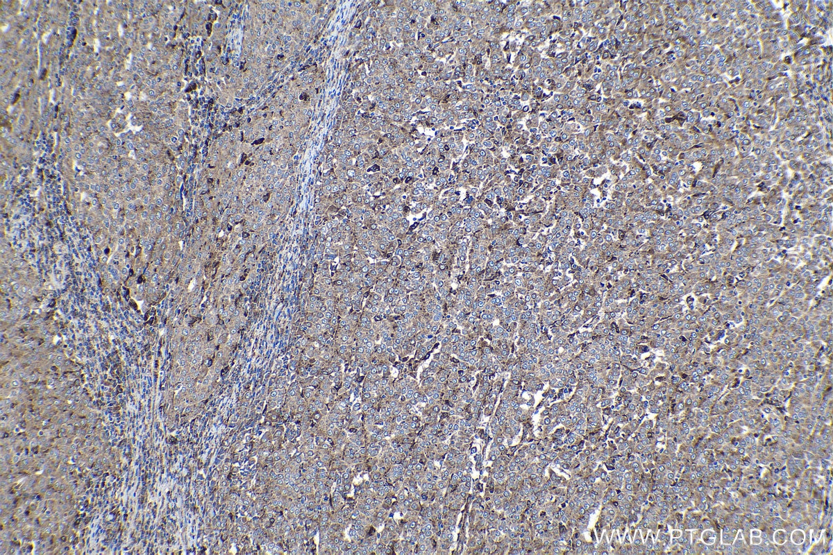 IHC staining of human ovary tumor using 18410-1-AP