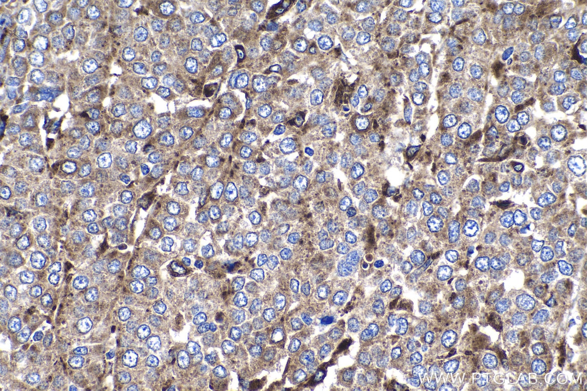 IHC staining of human ovary tumor using 18410-1-AP