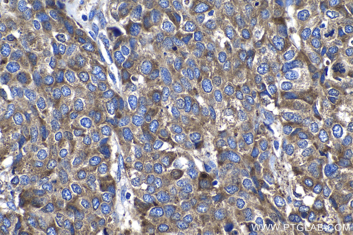 Immunohistochemistry (IHC) staining of human stomach cancer tissue using Granulin Polyclonal antibody (18410-1-AP)