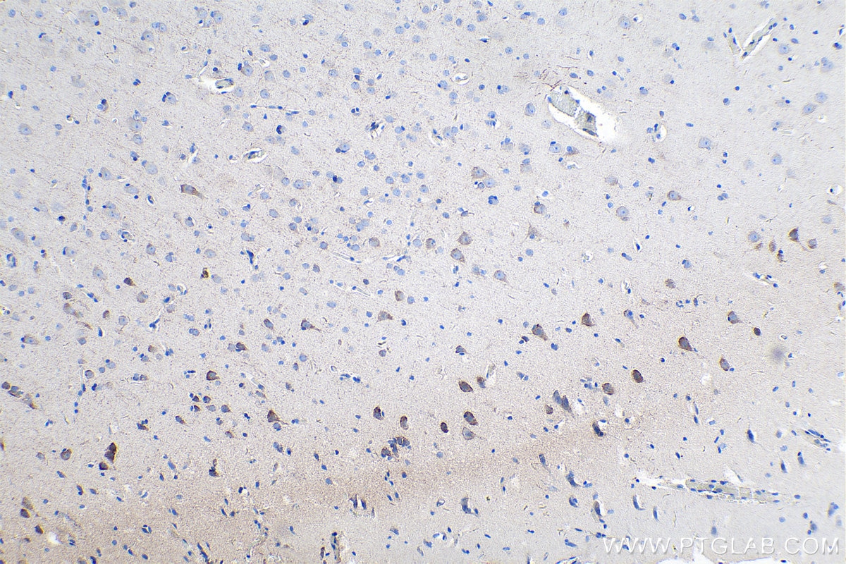 Immunohistochemistry (IHC) staining of human gliomas tissue using PCDH11X Polyclonal antibody (20070-1-AP)