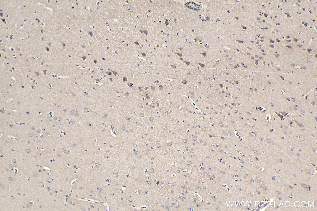 Immunohistochemistry (IHC) staining of human gliomas tissue using PCDH9 Polyclonal antibody (25090-1-AP)