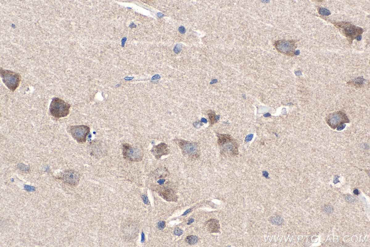 IHC staining of human gliomas using 25090-1-AP