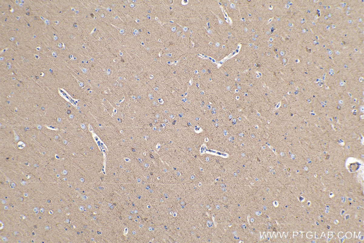 IHC staining of human gliomas using 15270-1-AP